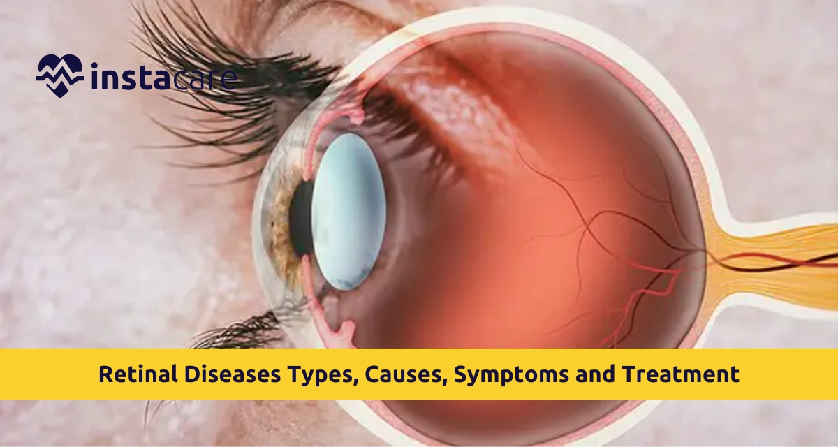 Picture of Retinal Diseases Types Causes Symptoms and Treatment