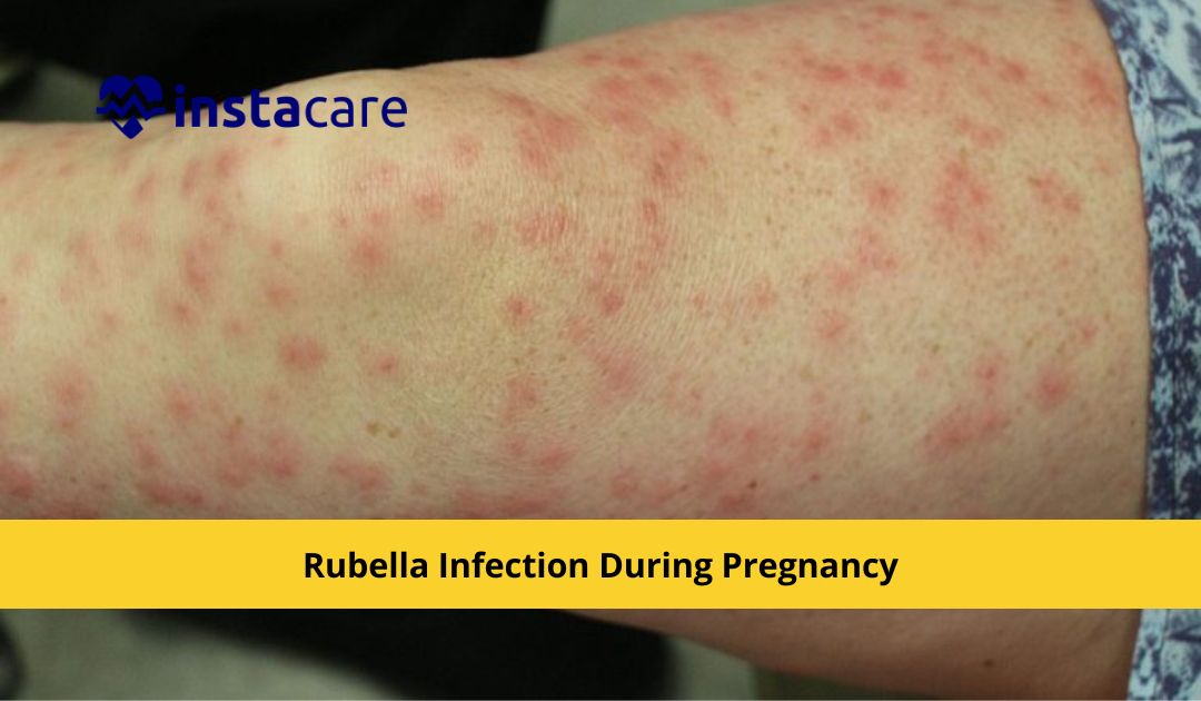 Picture of What You Must Know About Rubella Infection During Pregnancy