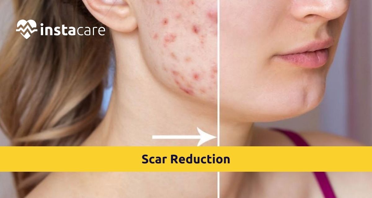 Picture of Ways To Deal With Scar Reduction - Dos And Donts Revealed