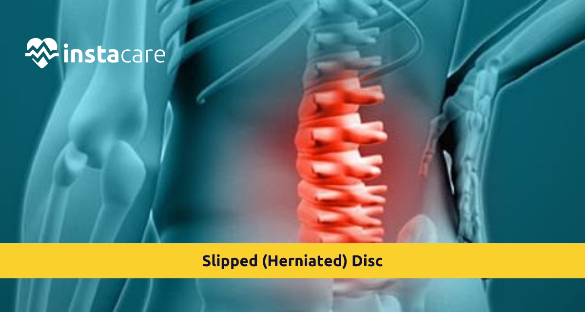 Picture of Slipped Herniated Disc