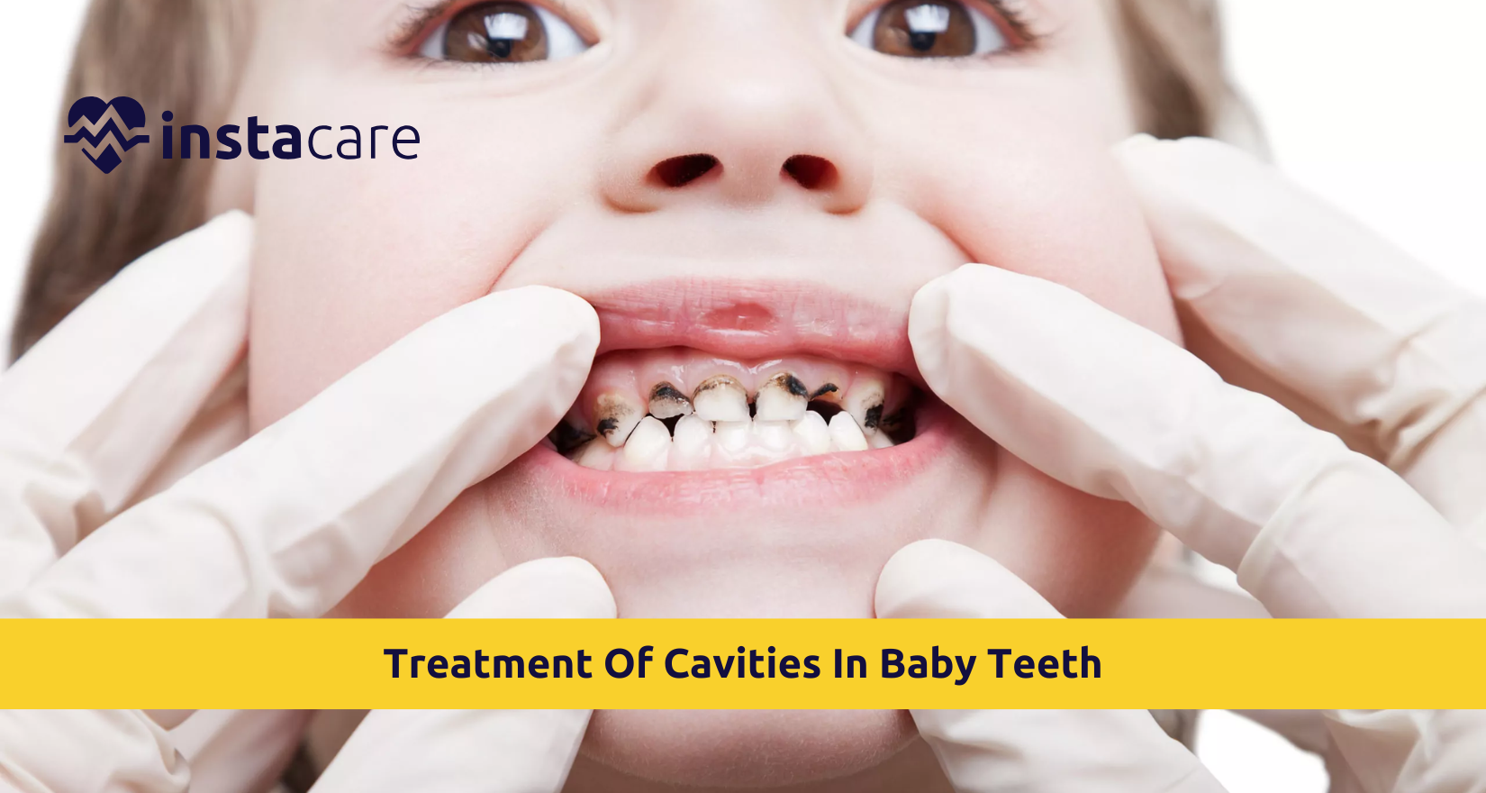 Picture of What Is The Treatment Of Cavities In Baby Teeth