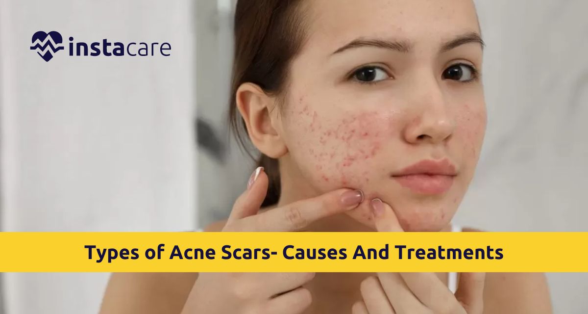 Understand The Types Of Acne Scars Causes And Treatments 6572