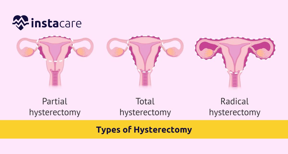 Picture of All You Must Know About The Types of Hysterectomy