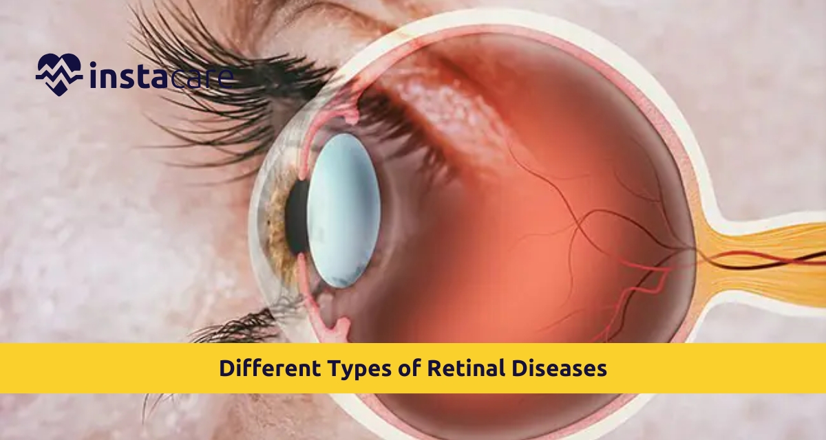 Picture of What Are the Different Types of Retinal Diseases