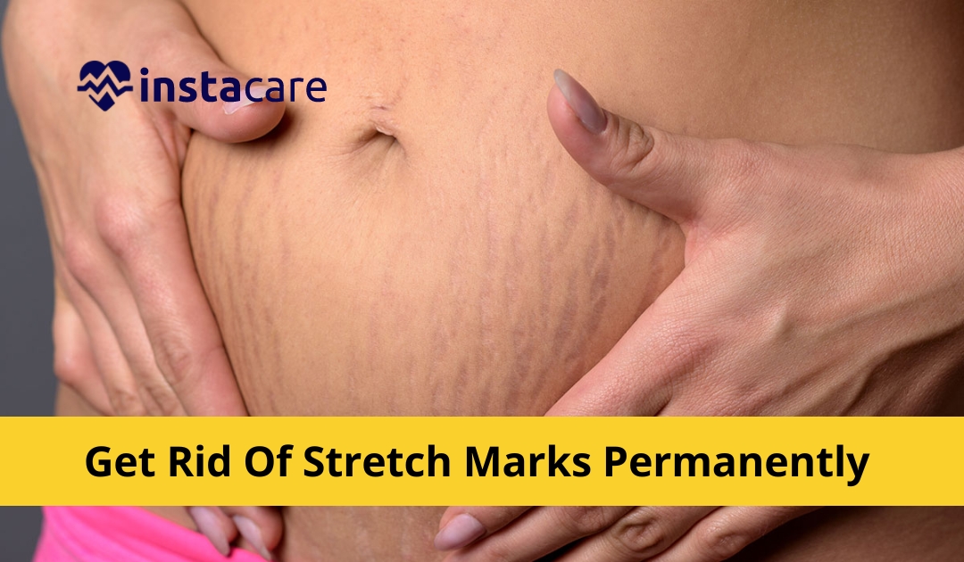 Picture of 8 Ways To Get Rid Of Stretch Marks Permanently Naturally