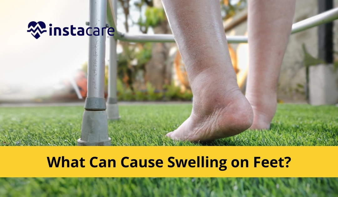 Picture of What Causes Swelling On Feet - 7 Causes Treatments And Remedies