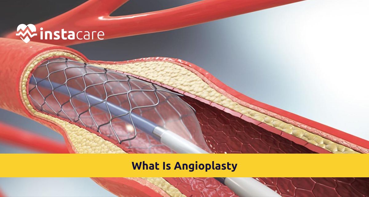 Picture of What Is Angioplasty All You Must Know About