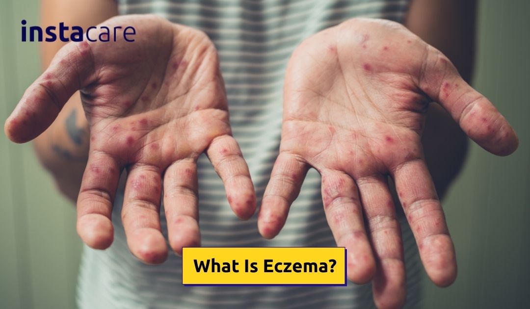 Picture of What Is Eczema and Why Does It Occur