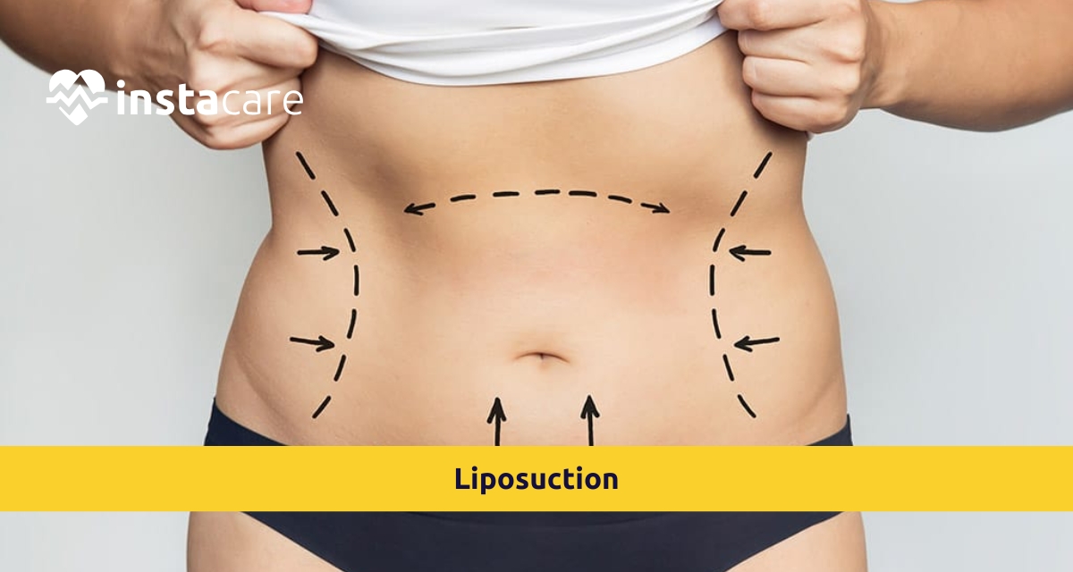 Picture of What is Liposuction Surgery Recovery Results