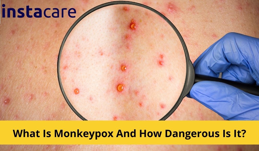 Picture of What Is Monkeypox And How Dangerous Is It