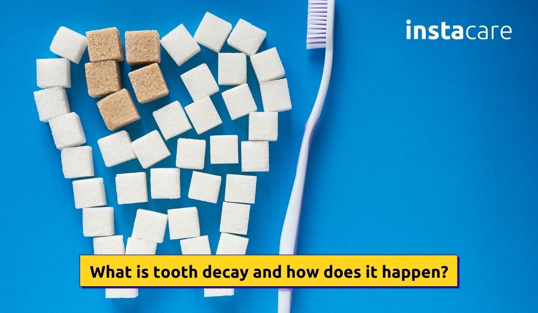 Picture of What Is Tooth Decay And Why Does It Occur