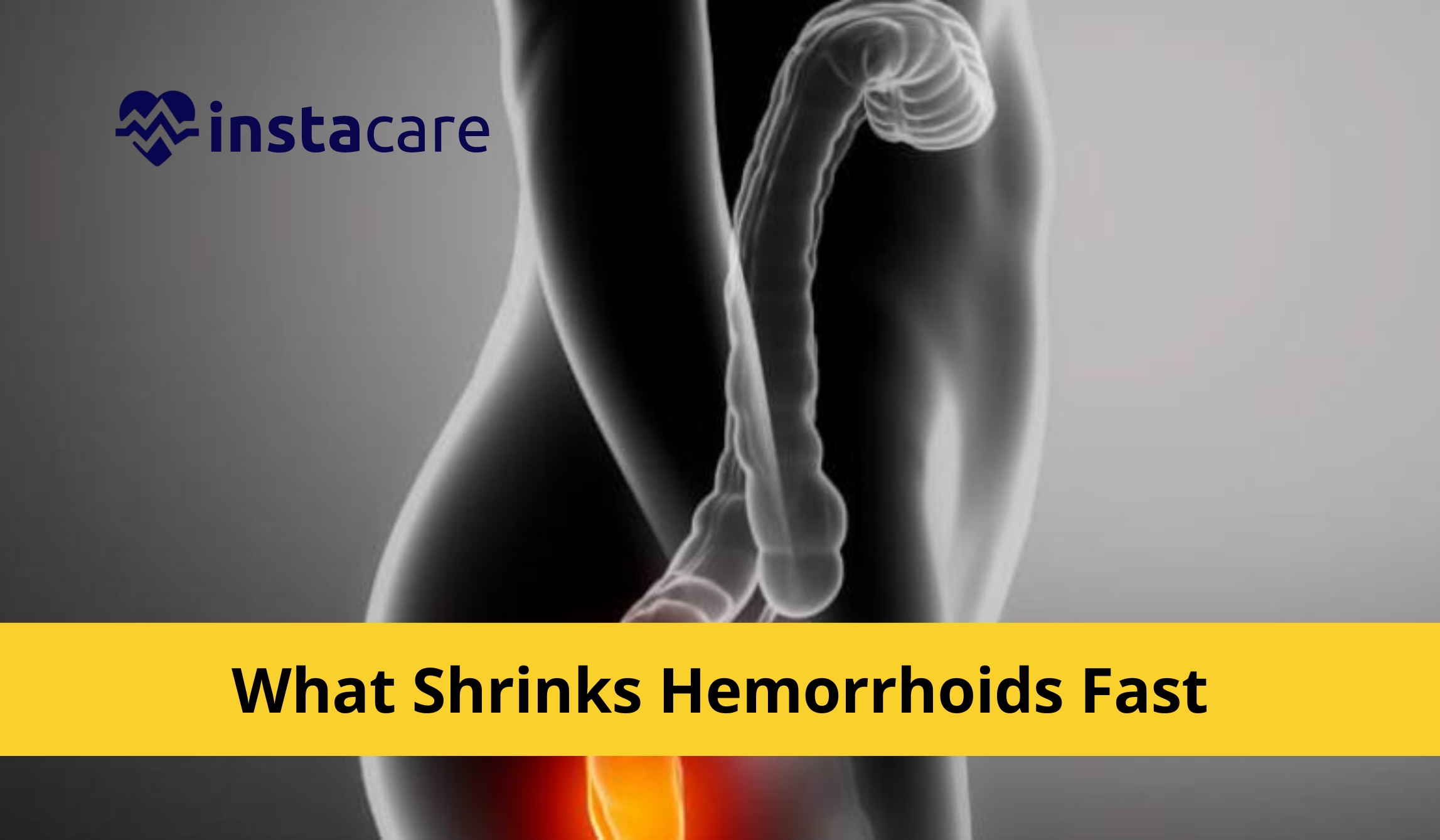 Picture of What Shrinks Hemorrhoids Fast Preventions And Treatments
