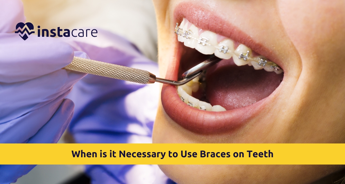 Picture of When is it Necessary to Use Braces on Teeth